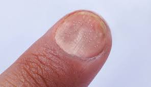 Image result for Pitting nails feet