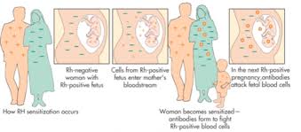 Image result for Rh Sensitization