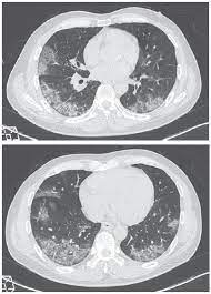 O que é pneumonia bacteriana? Pneumonia Por Covid 19 Qual O Papel Da Imagem No Diagnostico