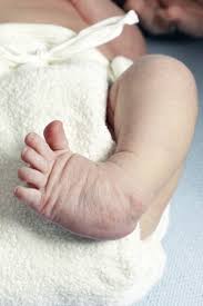 This is a photo of a newborn baby with a clubfoot. Babies Born With Clubfoot Clark Nj Foot Doctor