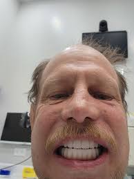 Tooth whitening before and after results