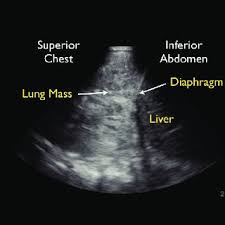 Pleural infection pleural inflammation pleural malignancy (most often pleural fluid analysis findings: Ultrasound Of A Loculated Pleural Effusion This Ultrasound Was Taken Download Scientific Diagram