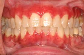 Image result for lichen planus on tongue)