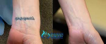 We did not find results for: Tattoo Removal Surgery Tattoo Removal Surgery Cost Iranian Surgery