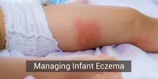 Eczema—a condition that causes the skin to become red, itchy, and inflamed—is one of the most common skin problems in babies. Is Your Baby S Eczema Or Rashes Due To Hard Water Causes And Prevention