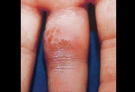 Most hsv infections are easy for physicians to diagnose. Herpes Zoster Picture Image On Medicinenet Com