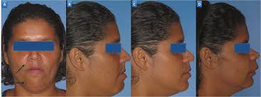 Reposición Maxilar y Reconstrucción con Injerto de Cresta Iliaca. Parte 1.  Indicaciones y Técnica