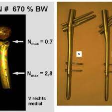Pdf Spannungsoptische Untersuchung Verschiedener Stabilisierungsverfahren Dynamische Huftschraube Gamma Nagel Proximaler Femur Nagel Bei Pertrochantaren Femurfrakturen