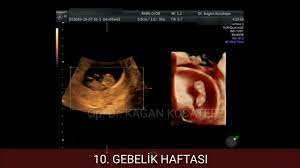 10 gebelik haftasinda 2 aylik bebegin goruntuleri kollar bacaklar bebek ultrason bacaklar koltuklar