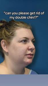 SAGAR PATEL MD Buccal l Chin Lipo l Ear Pinning (@sagarpatelaesthetics) •  Instagram photos and videos