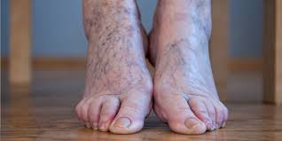 Are Varicose Veins Dangerous Pristyn Care