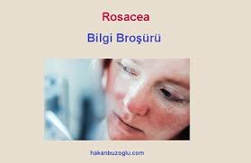 Rozasea Nin Tedavisi