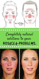 Completely Natural Solutions To Your Rosacea Problems Natural Remedies For Rosacea Natural Rosacea Treatment Essential Oils For Rosacea
