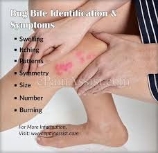 Bug Bites That Look Like Mosquito Bites But Aren T Pin On Articles