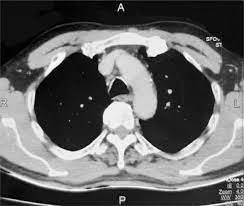 No patient experience ratingswhy not? Erdheim Chester Disease A Subtle Quiddity The First Case Reported From Nepal Sciencedirect