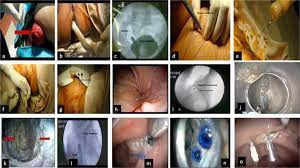 Rectal prolapse is usually caused by a weakening of the muscles that support the rectum. Per Anal Endoscopic Rectopexy For Treatment Of Complete Rectal Prolapse A Preliminary Report Springerlink