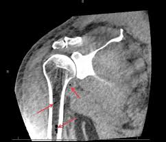 Image result for Decompression Sickness