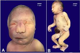 Trisomy 13 with unusual histological features typically described in  Beckwith-Wiedemann Spectrum