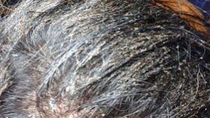 Image result for white scabs on the head in children