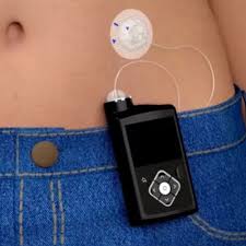 Insulin pump therapy