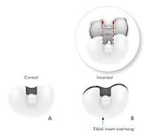 PS SURGICAL TECHNIQUE