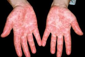 Pe can exist as a primary physiologic finding or as a secondary marker of systemic pathology. Skin Changes And Complaints In Pregnancy Gponline