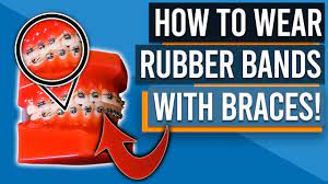 How To Put Rubber Bands On Braces Premier Orthodontics
