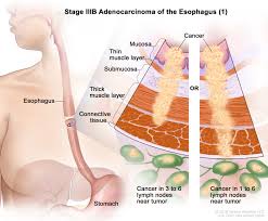 Esophageal Cancer Treatment Adult Pdq Patient Version National Cancer Institute