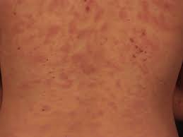 Check spelling or type a new query. Lichen Planus Exanthematicus Altmeyers Enzyklopadie Fachbereich Dermatologie
