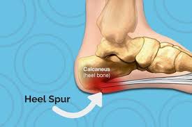 The 411 On Heel Spurs How To Treat And Prevent It A Heel Spur Is A Calcium Deposit That Causes A Heel Spurs Plantar Fasciitis Remedies Heal Spur Remedies