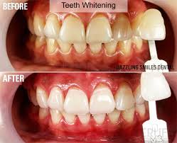 Teeth whitening costs around руб.26798 in malaysia. Dazzling Smiles Dental Dental Price Reviews Erufu Care