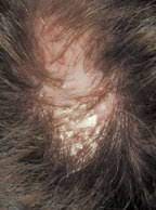 Hepatitis c, a virus that. Lichen Planus And The Link To Hair Loss
