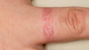 Image result for dermatitis contacta children