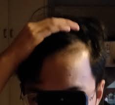 17m Hi Reddit Do I Have A Receding Hairline Hair Beauty Skin Deals Me Fashion Love Cute Styl Celebrity Hair Colors Hairline Celebrity Hairstyles