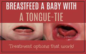 Breastfeeding A Tongue Tied Baby And Treatment Options That Work