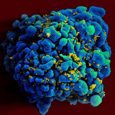 If hiv is not treated, it can lead to aids (acquired immunodeficiency syndrome). A Woman May Have Been Cured Of H I V Without Medical Treatment The New York Times
