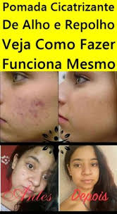 poderosa pomada cicatrizante de alho e repolho dicas para emagrecer cicatrizante dicas caseiras