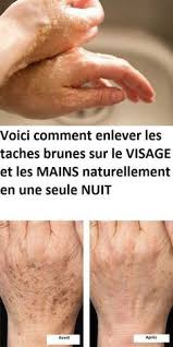 Voici Comment Enlever Les Taches Brunes Sur Le Visage Et Les Mains Naturellement En Une Seule Nuit Beauty Care Beauty Hacks Spots On Face