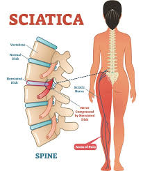 Because it can be a symptom of an. Can Prolonged Sitting Cause Sciatica What You Should Know