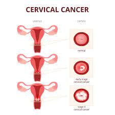 { two cell types present (squamous and glandular). Cervical Cancer Diagnosis And Treatment Options