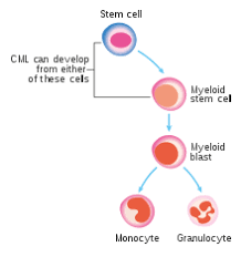Chronic Myelogenous Leukemia Wikipedia