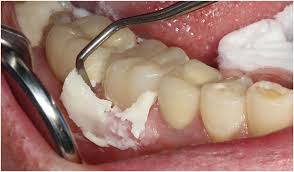 They may be able to tell you if dental clinics nearby have received grants for implants for seniors. Understanding Modern Resin Cementation Dentistry Today