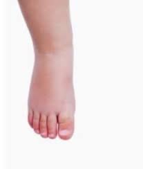 See full list on wikihow.com Lymphedema Houston Vein Specialists Swollen Ankles