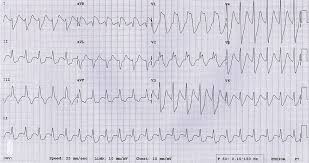 Image result for Right Axis Deviation