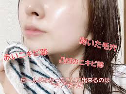 凸凹ニキビ跡に赤いニキビ跡 治す近道はアレを使うこと ニキビ跡 ニキビ ニキビケア