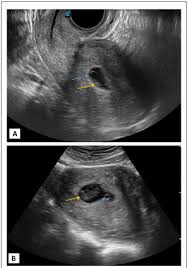 We did not find results for: A Normal Fetal Pole Yellow Arrow And Ys Blue Arrow In A Patient Download Scientific Diagram