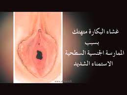 غشاء البكاره التجميل والاطمئنان العياده posts facebook