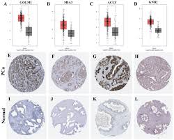 The pancreas is located behind the stomach, so having pancreatic cancer doesn't involve a palpable mass that you can feel. Identification Of Potential Diagnostic And Prognostic Biomarkers For Prostate Cancer