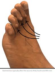 Claw toes result from an inherent muscle imbalance. Hammer Toe Symptoms Causes And Surgery London Foot And Ankle Surgery