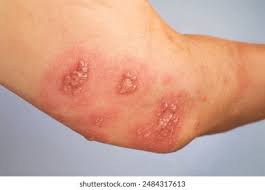 Image result for scabies bite